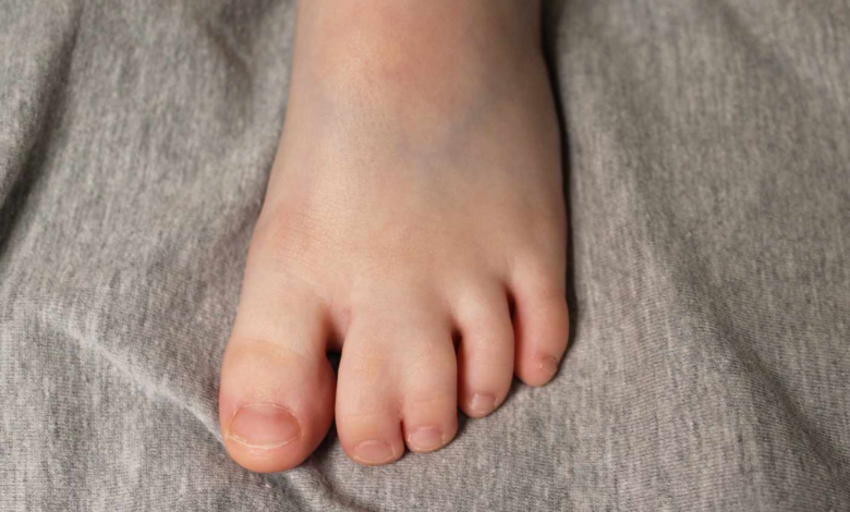 Human Webbed Feet